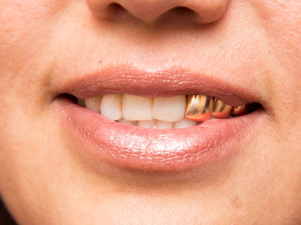 دندان روکش طلا دائمی